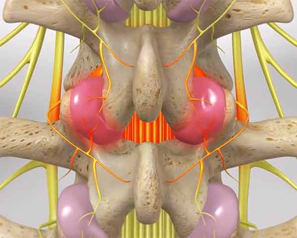 Medial-branch-nerve-block-shoreside-pain-sarasota-florida illustration of medial branch inflamed. Shoreside interventional Pain, Rogers, AR