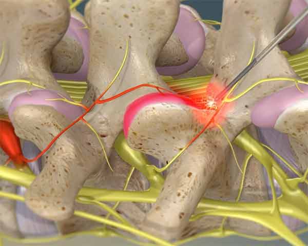 Radiofrequency-nerve-ablation-pain-clinic-sarasota-florida pain management clinic that uses radiofrequency nerve ablation to treat painful facet joints.