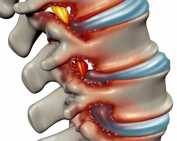 Spinal-stenosis-shoreside-pain-sarasota-florida Illustration of spinal stenosis in spine. NWA Interventional Pain in Rogers, AR.