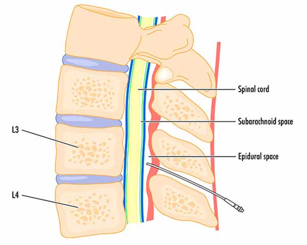epidural-steroid-injection-shoreside-pain-sarasota-florida Illustration showing epidural injection location. NWA Interventional Pain in Rogers, Arkansas.