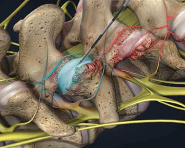 facet-joint-injections-pain-management Pain management for facet joint. Facet Joint injection.