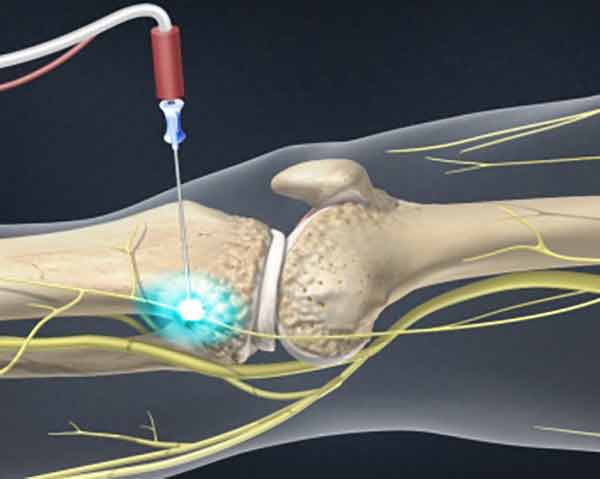 genicular-nerve-ablation-pain-management-shoreside-pain Pain management for knee pain in Rogers, AR.