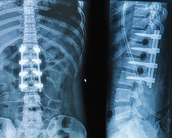 hardware-injections-pain-management-clinic-sarasota-flroida Hardware injection in your back x-ray. NWA Interventional Pain a sarasota pain management clinic.