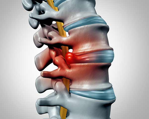 herniated-disk-pain-shoreside-pain-sarasota-FL Illustration of herniated disk in spine. NWA Interventional Pain, Rogers, AR.