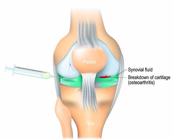joint-injection-shoreside-pain-sarasota-florida Illustration of a knee joint being injected for treatment at NWA Interventional Pain in Rogers, AR.