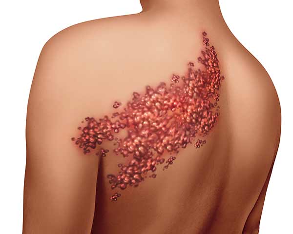 painful-herpes-zoster-shingles-treatment-shoreside-pain-sarasota-florida Illustration of shingles on skin. Shoreside Pain Treatment, Rogers, AR.