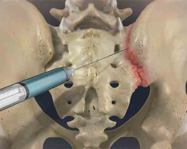 sacroiliac-joint-injection-pain-management-sarasota-fl Illustration of a sacroiliac injection for pain management in Rogers, AR.