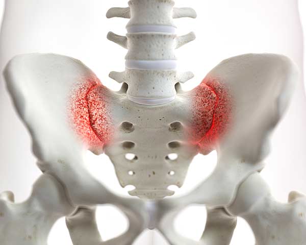 sacroiliac-joint-pain-shoreside-pain-sarasota-florida Illustration of Sacroiliac joint pain. NWA Interventional Pain in Rogers, Arkansas