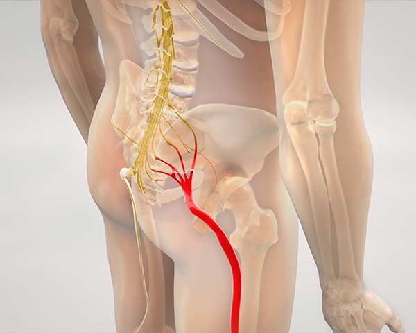 sciatic-nerve-pain-shoreside-pain-sarasota-florida Illustration of sciatic nerve from hip to leg. NWA Interventional Pain in Rogers, AR.