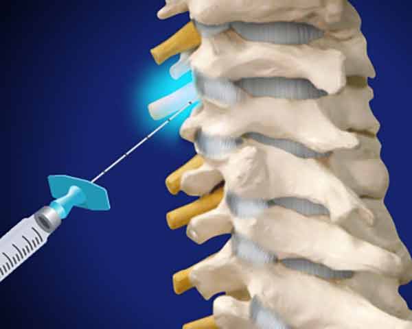selective-nerve-root-block-pain-management-sarasota-florida Injections for pain management, selective nerve root block illustration.