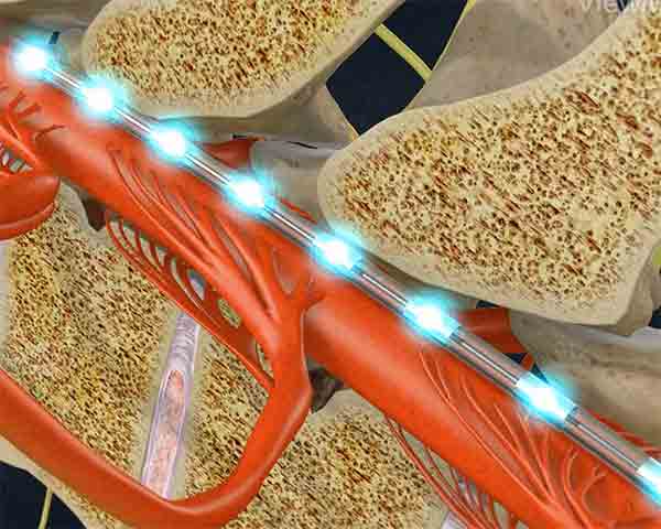spinal-cord-stimulation-pain-management-sarasota-florida Illustration of spinal cord stimulation for pain management in Rogers, AR.