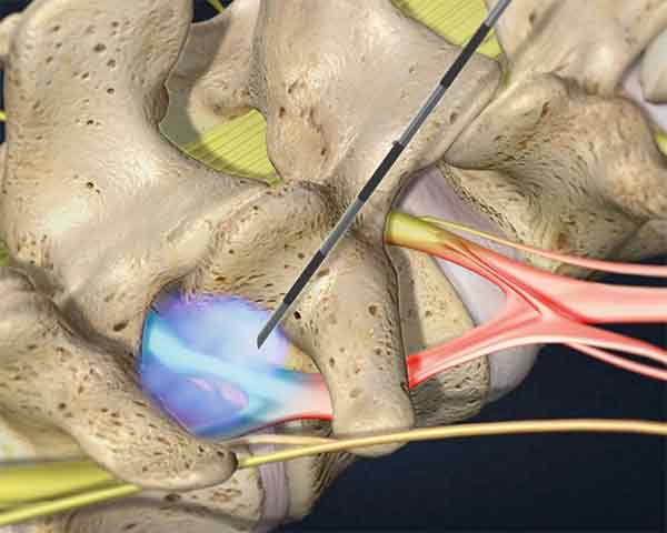 transforaminal-epidural-steroid-injection-shoreside-pain-sarasota-florida