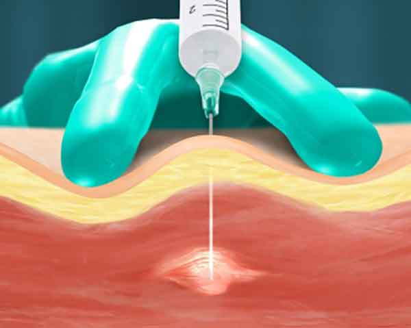 trigger-point-injections-sarasota-florida Pain management with trigger point injections illustration. Shoresline Interventional Pain, Rogers, AR.